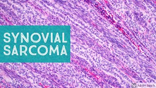 Synovial Sarcoma 101…Explained by a Soft Tissue Pathologist [upl. by Ymac899]