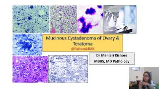 mucinous cystadenoma ovary amp teratoma ovary [upl. by Erda]