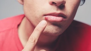 Dermatologist explains causes of cold sores [upl. by Weirick]