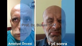 Yüz felci ameliyatı  Prof Dr Bülent DÜZ [upl. by Novyat201]