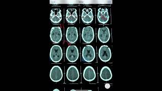 CT BRAIN  SUB ARACHNOID HEMORRHAGE  OBSTRUCTIVE HYDROCEPHALUSDURAL AV FISTULA [upl. by Enerual]