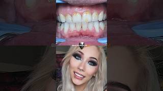 5 Outstanding Smile Makeover Results [upl. by Airtina]