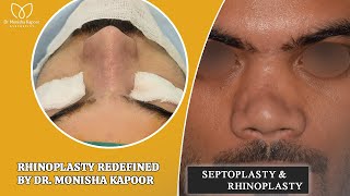 Complicated Revision Rhinoplasty Case Performed by Dr Monisha Kapoor explore result vlog [upl. by Asirak237]