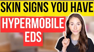 Unlocking The Secrets 12 Surprising Skin Signs Of Hypermobile EhlersDanlos Syndrome [upl. by Getraer332]