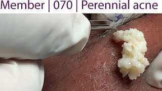 Acne Treatment Huong Da Nang 070  Perennial acne [upl. by Hui]