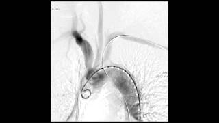 Cerebral angiography 34 [upl. by Yenobe367]