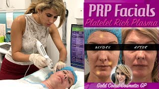 PRP quotVampirequot Facials  First Treatment  Before amp After  Analysis [upl. by Lukas]