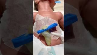 Umbilical cord newbornbaby medical viralvideo [upl. by Scrivenor]