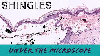 Shingles under the microscope VZV Varicella Zoster Herpes pathology dermpath dermatopathology [upl. by Lebaron]