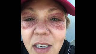 Fibroblast eye treatment 7 day video diary [upl. by Jonna]