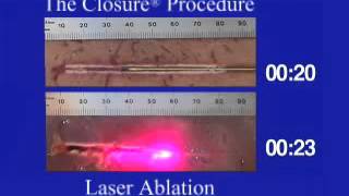 Laser Ablation vs Radiofrequency Ablation [upl. by Lozano733]