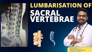 Lumbarization Of Sacral VertebraDr Sai Chandra MBBS DNB Ortho [upl. by Enyala564]