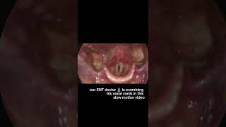 Vocal Stroboscopy Video [upl. by Arua]