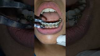 Braces removal  Braces removal by dentist  Braces debonding  Braces treatment  Sitamarhi teeth [upl. by Halverson]