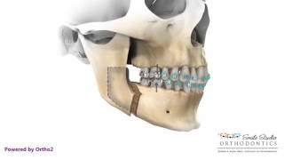 BSSO Mandibular Advancement [upl. by Anawak]