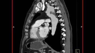 4D Imaging of the Aortic Valve Repaired coarctation of the aorta 2 of 3 [upl. by Eldnik]