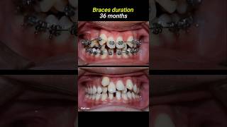 Braces for crowded teeth braces orthodontist dentistry dentist [upl. by Eceer]