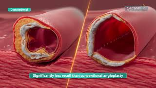 Serranator PTA Serration Balloon Catheter  Mechanism of Action [upl. by Enymzaj161]