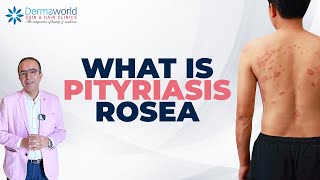 Skin Rash Pityriasis Rosea Hai  Symptoms Aur Treatment Explained  dermaworldskinclinics [upl. by Purdy]