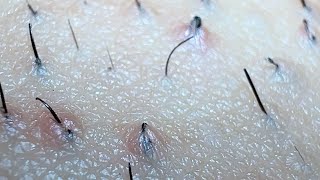 JUICY SATISFYING INGROWN HAIR PULL😍😍😍 [upl. by Athelstan]