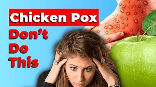 3 Chicken Pox MISTAKES you are doing [upl. by Annawal494]