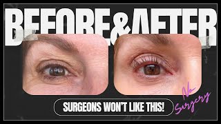 SKIP the surgery This eyelid treatment WORKS TIXEL eyelid LIFT [upl. by Tiffanle]