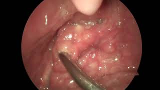 숨은 편도결석 제거 removal of tonsil stones [upl. by Serge]