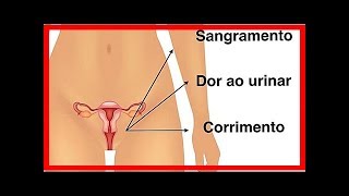 Symptome von Chlamydien bei Männern und Frauen [upl. by Arbas]