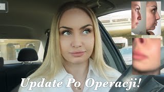 10 MIESIĘCY PO OPERACJI NOSA  update 🥰 [upl. by Nomra]