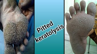 Pitted Keratolysis [upl. by Lemay386]