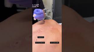 Mole Removal with Radiofrequency at StudioMD moleremovaltreatment [upl. by Aerdnua411]