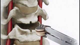 SecureC Cervical artificial disc Replacement Hussien ElMaghraby [upl. by Dinsdale]