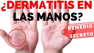 👋 Como curar la dermatitis en las manos  Remedio Secreto REVELADO [upl. by Esidarap617]