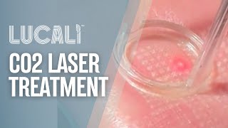 CO2 Laser Resurfacing Treatment [upl. by Rimidalv]