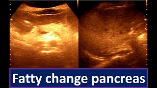 Moderately diffuse fatty infiltration of the Liver  Fatty change pancreas [upl. by Alehtse]