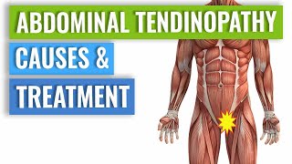 Abdominal Tendinopathy  Causes and Treatment Including Exercises [upl. by Pantia]