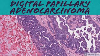 Aggressive Digital Papillary Adenocarcinoma 101 [upl. by Inatsed]