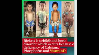 Understanding Rickets A Childhood Bone Disorder [upl. by Anirhtak50]