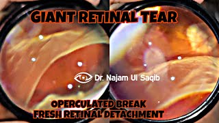 Giant Retinal TearGRT And Operculated Break In A Fresh Retinal Detachment [upl. by Ilujna]