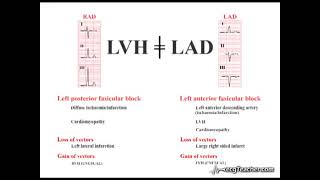 Axis Deviation Causes [upl. by Monarski781]