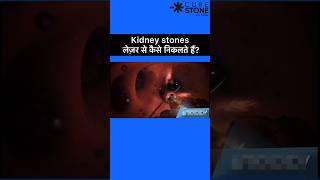 Kidney stones Treatment  RIRS  Laser kidney stone treatment shorts [upl. by Adnalahs]