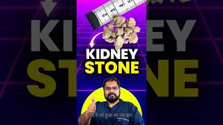 Stone treatment in India kidneystone [upl. by Noed331]