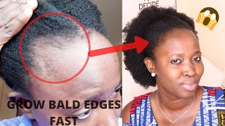 THIS TREATMENT WILL GROW amp TREAT YOUR BALDNESS amp THIN EDGES FAST IN 1 MONTHUse 3 times weekly [upl. by Kudva]