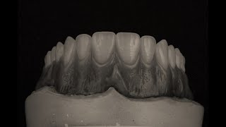 Escultura Gingival y Festoneado en Prostodoncia Total Superior [upl. by Iclek]