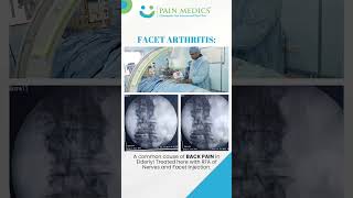 Facet Joint Arthritis is a Common Cause of Back Pain in E lderly painmedics painrelief [upl. by Wieren]