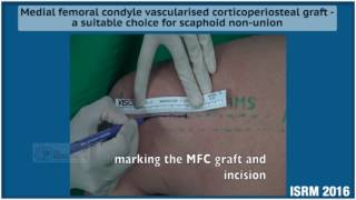 Medial femoral condyle vascularised corticoperiosteal graft [upl. by Setarcos]