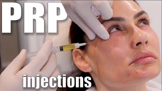 PRP Injections to Face and Neck Blood Facial [upl. by Yelsnia391]