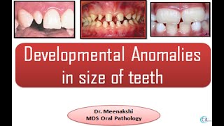 Developmental disturbances in Size of teeth [upl. by Desmund]