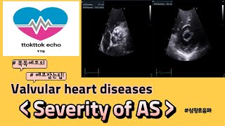 Severity of AS aortic stenosis AS  VHD echocardiography 심장초음파 heart echo view [upl. by Ennairod642]