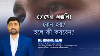 Chalazion treatment চোখের অঞ্জনি কেন হয়Dr Mominul Islam [upl. by Tse]